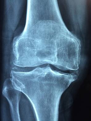 Osteoarthritic knee xray image