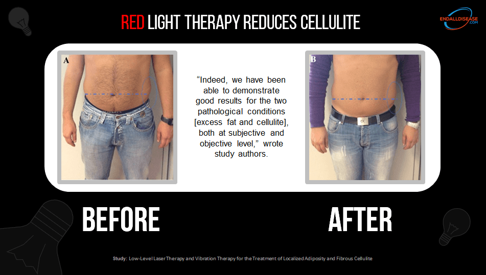 cellulite and subcutaneous fat reduced using red light therapy